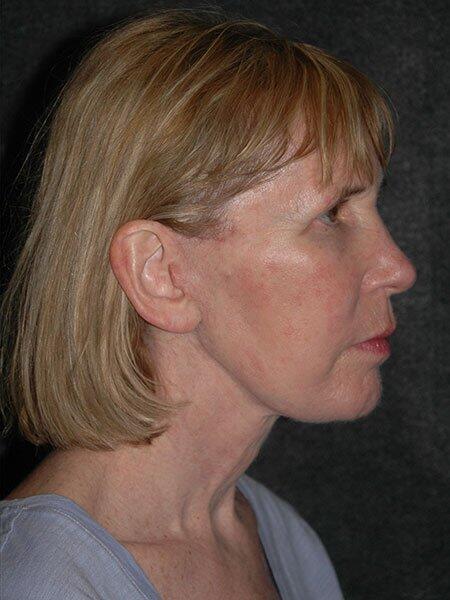 Facelift & Neck Lift Before & After Photo