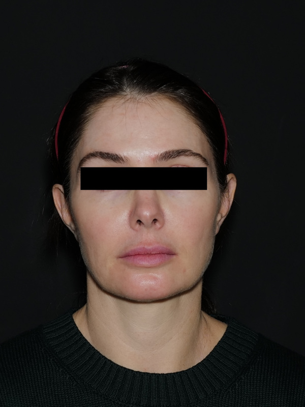 Facelift & Neck Lift Before & After Photo