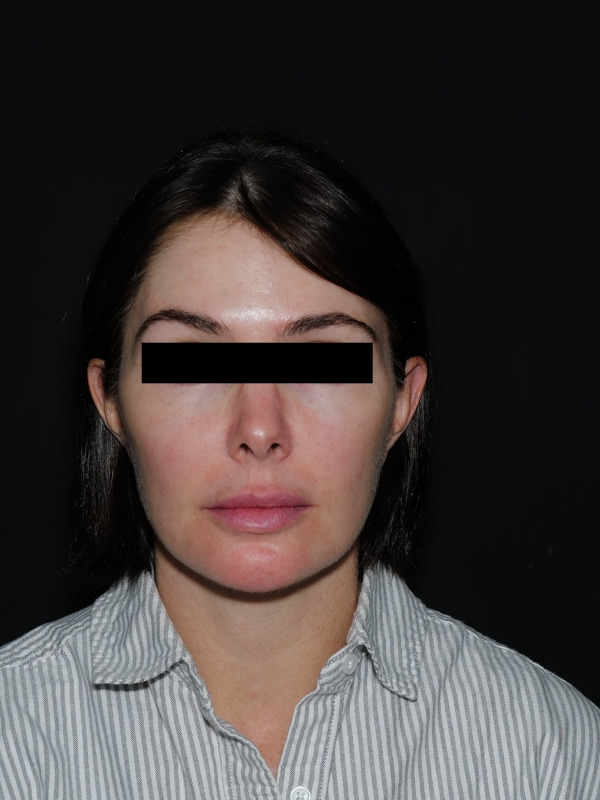 Facelift & Neck Lift Before & After Photo