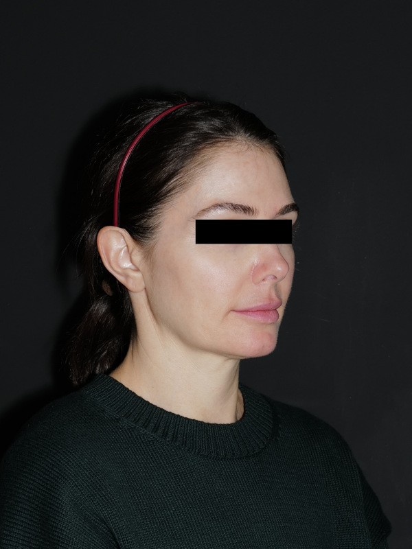 Facelift & Neck Lift Before & After Photo