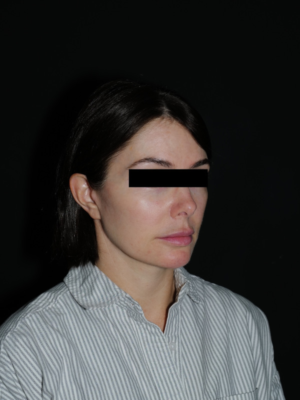 Facelift & Neck Lift Before & After Photo