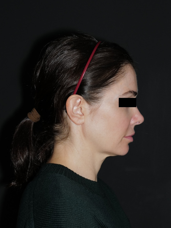 Facelift & Neck Lift Before & After Photo