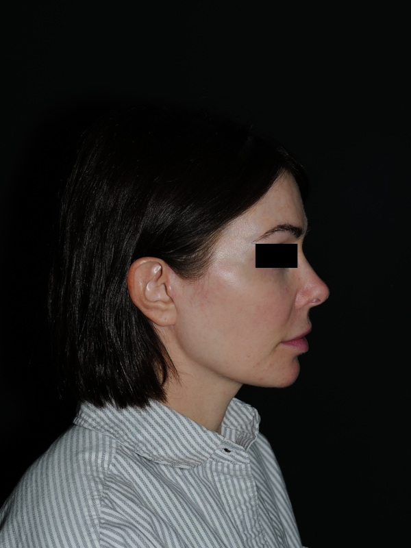 Facelift & Neck Lift Before & After Photo