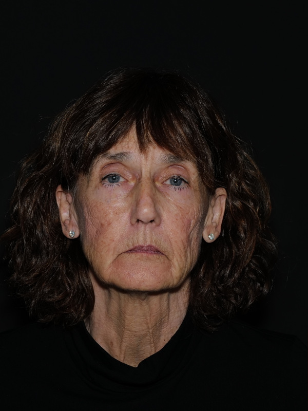 Facelift & Neck Lift Before & After Photo