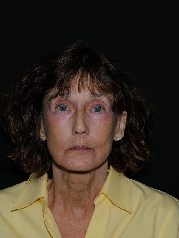 Facelift & Neck Lift Before & After Photo