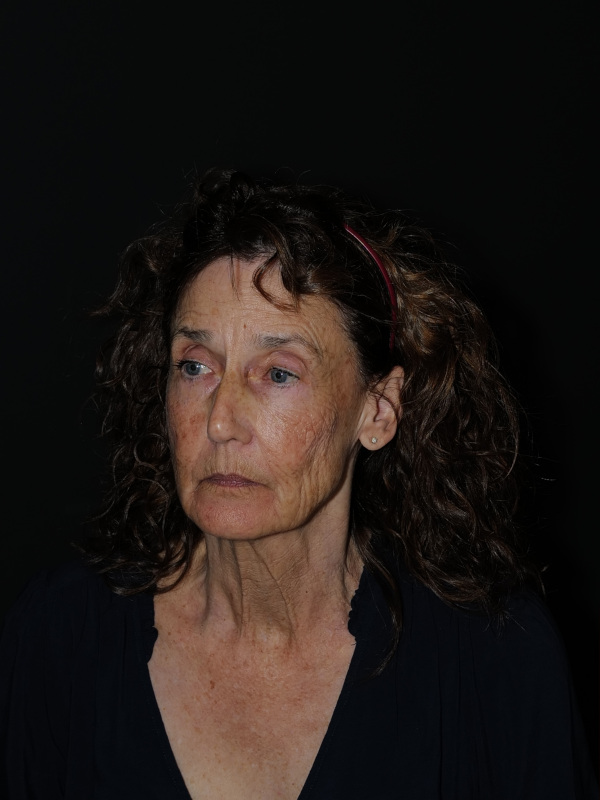 Facelift & Neck Lift Before & After Photo