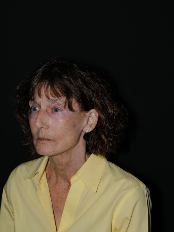 Facelift & Neck Lift Before & After Photo