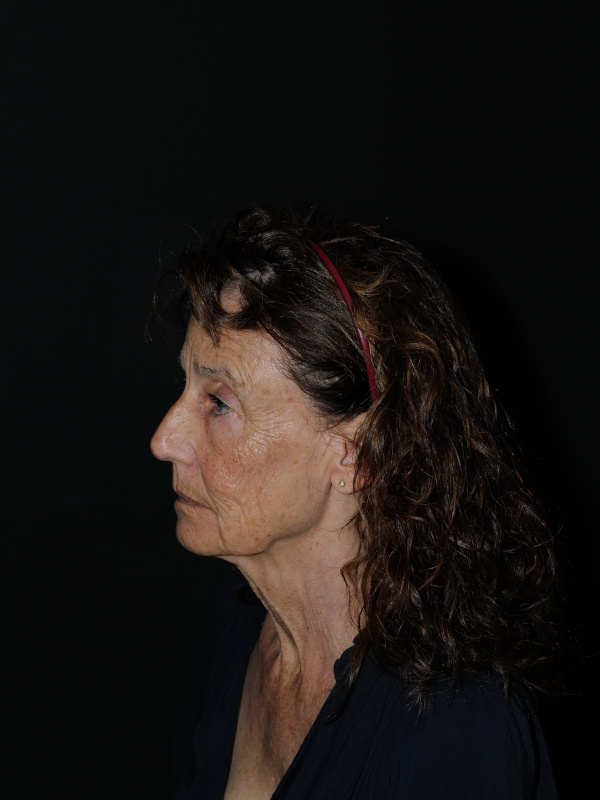 Facelift & Neck Lift Before & After Photo
