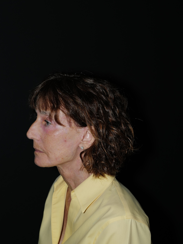 Facelift & Neck Lift Before & After Photo