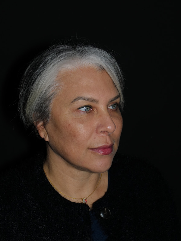 Facelift & Neck Lift Before & After Photo