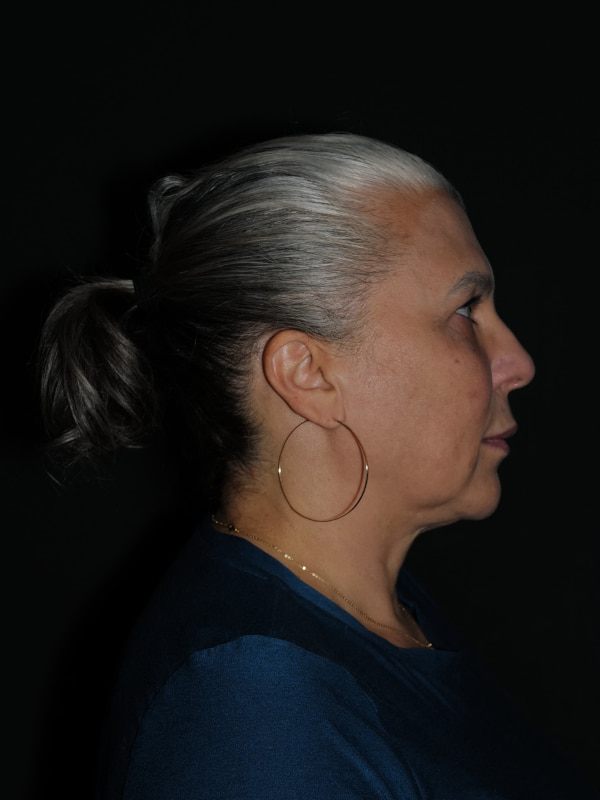 Facelift & Neck Lift Before & After Photo