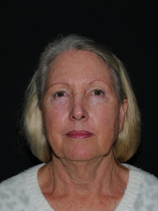 Facelift & Neck Lift Before & After Photo