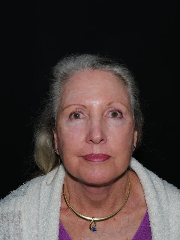 Facelift & Neck Lift Before & After Photo