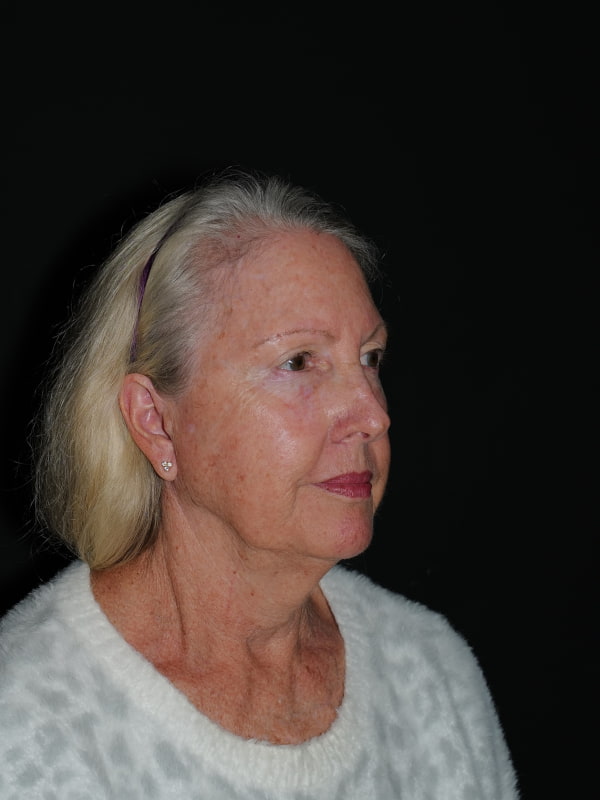 Facelift & Neck Lift Before & After Photo