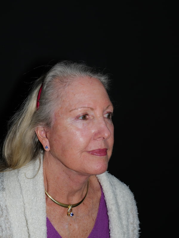 Facelift & Neck Lift Before & After Photo