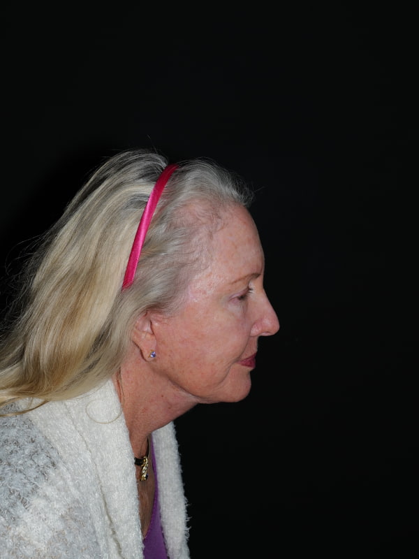 Facelift & Neck Lift Before & After Photo