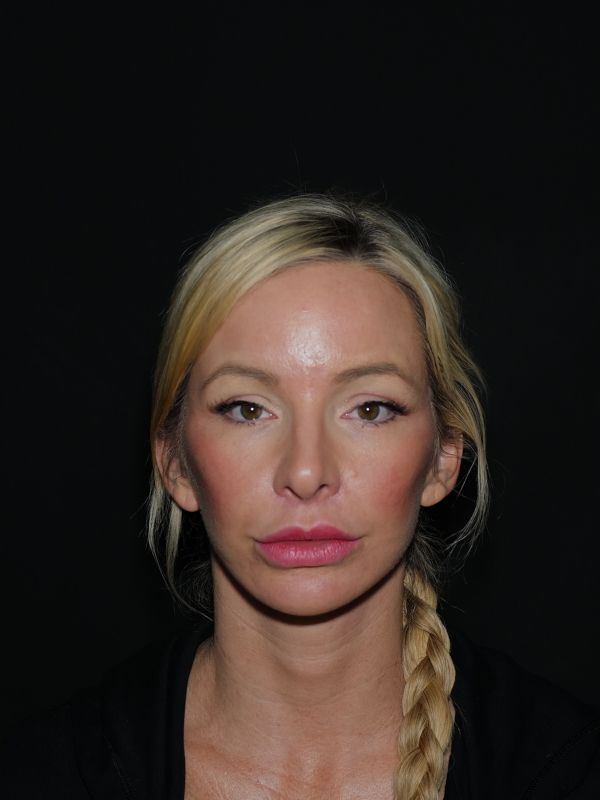 Facelift & Neck Lift Before & After Photo