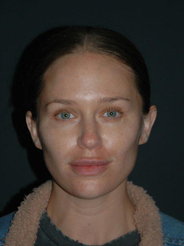 Non-Surgical Facelift Before & After Photo