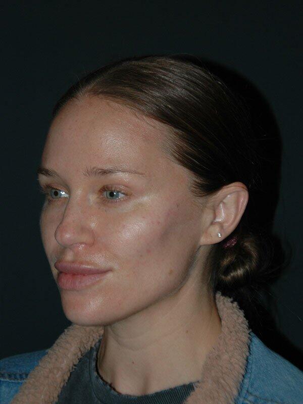 Non-Surgical Facelift Before & After Photo