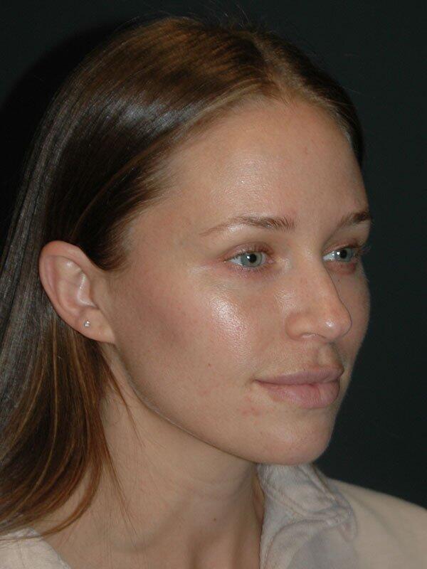 Non-Surgical Facelift Before & After Photo