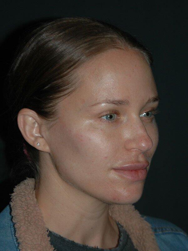 Non-Surgical Facelift Before & After Photo