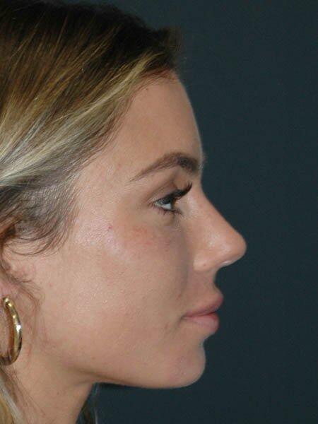 Non-Surgical Facelift Before & After Photo