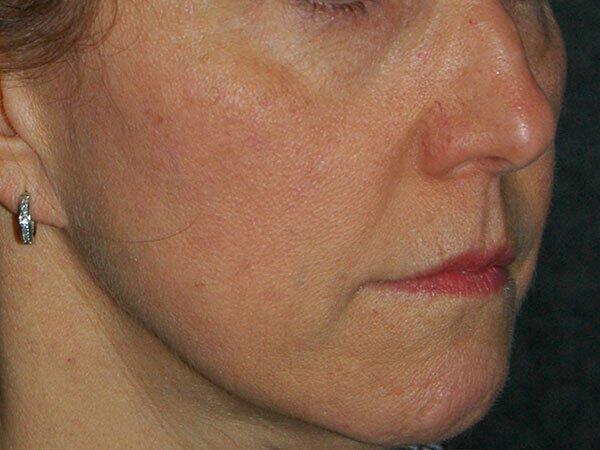 Non-Surgical Facelift Before & After Photo