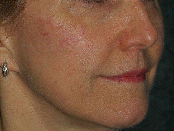 Non-Surgical Facelift Before & After Photo