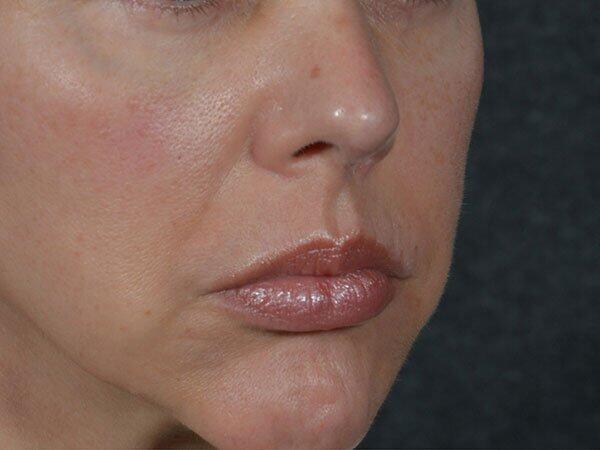 Non-Surgical Facelift Before & After Photo