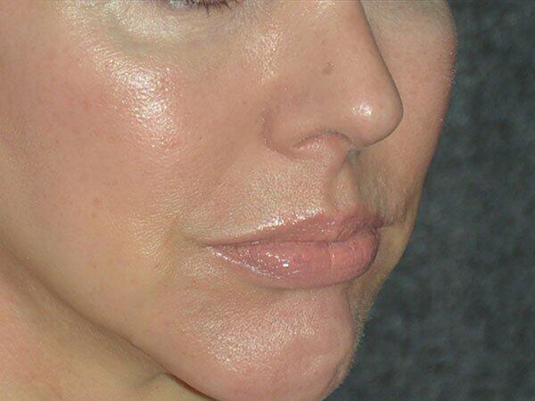 Non-Surgical Facelift Before & After Photo