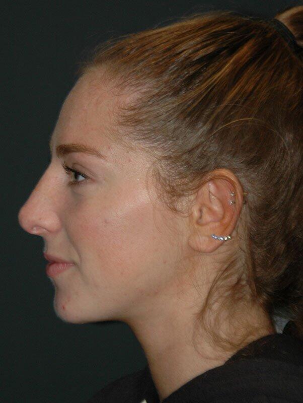 Non Surgical Rhinoplasty Before & After Photo