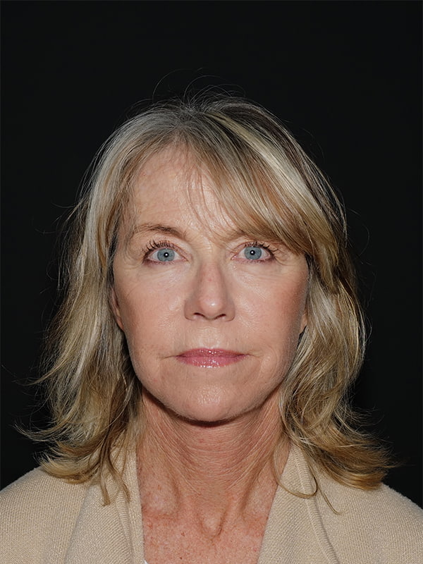 Blepharoplasty Before & After Photo
