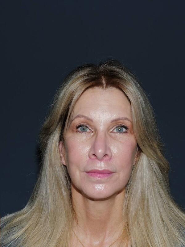 Blepharoplasty Before & After Photo