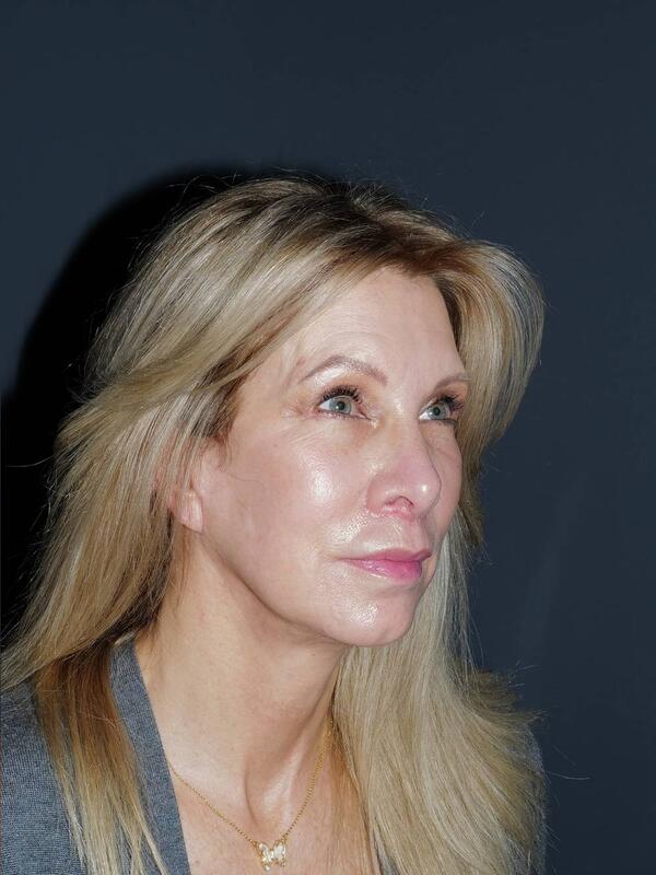 Blepharoplasty Before & After Photo