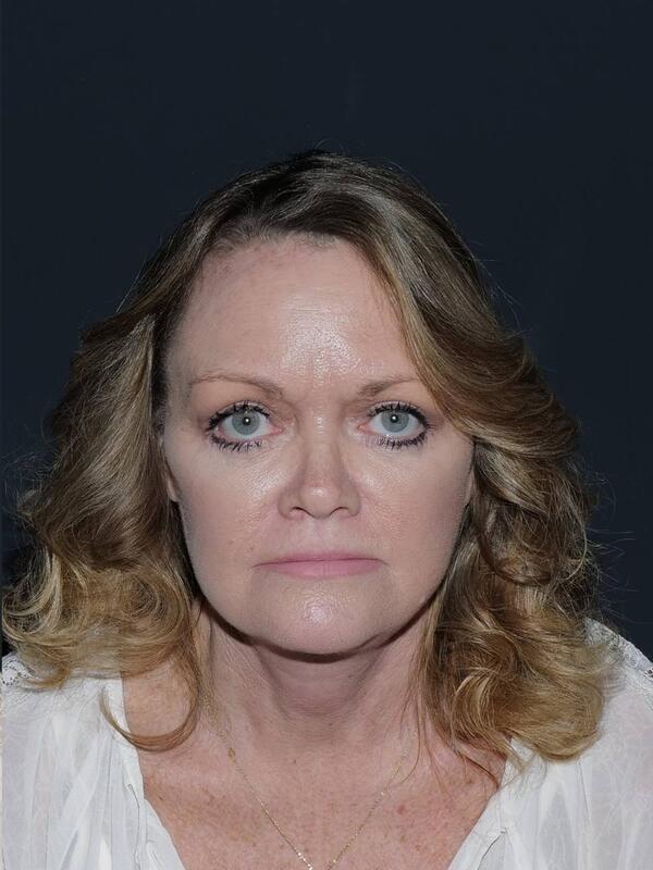 Blepharoplasty Before & After Photo