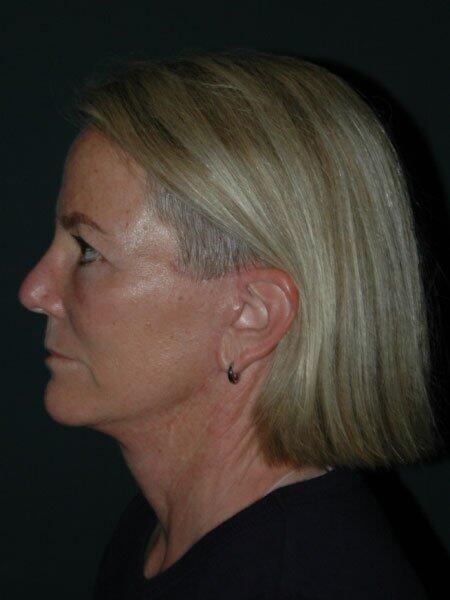 Blepharoplasty Before & After Photo