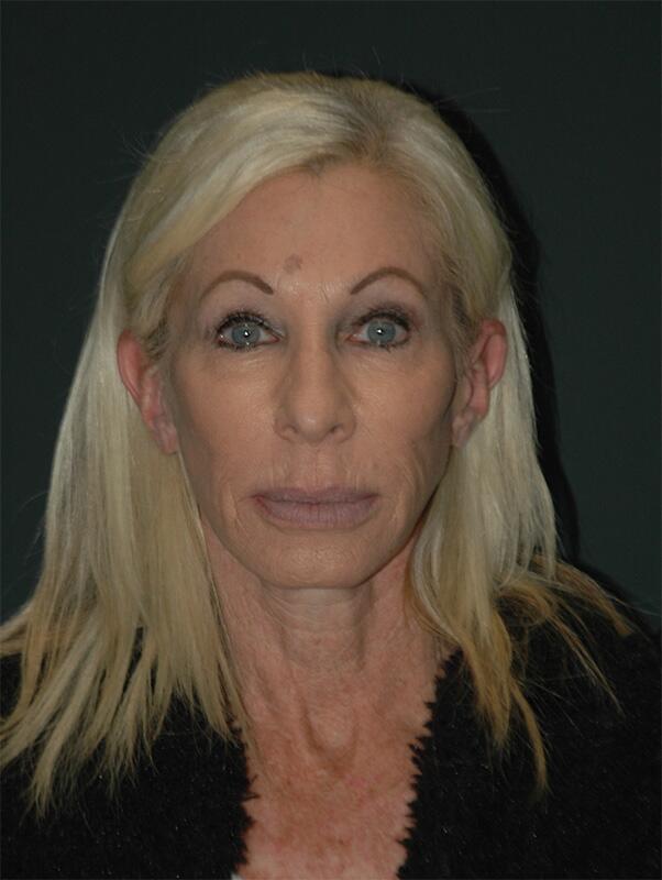 Blepharoplasty Before & After Photo