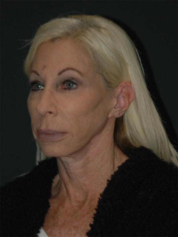 Blepharoplasty Before & After Photo