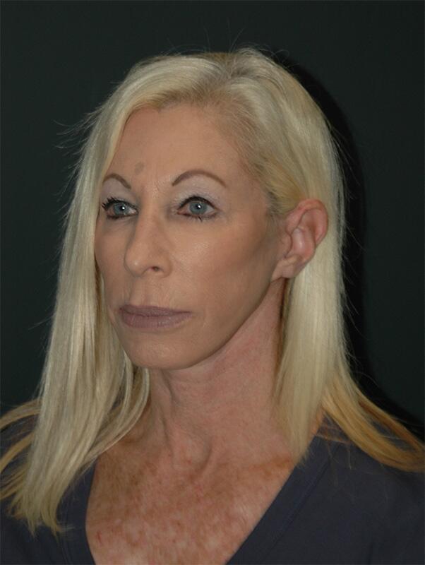 Blepharoplasty Before & After Photo