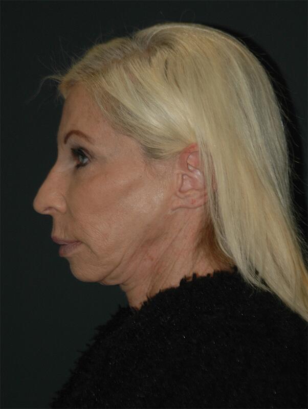 Blepharoplasty Before & After Photo