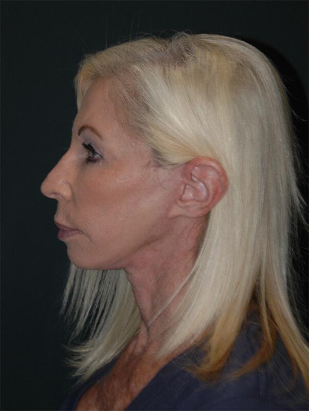 Blepharoplasty Before & After Photo