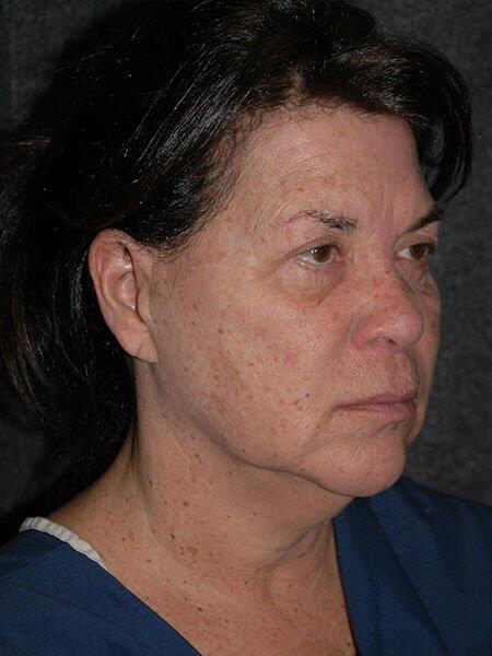 Blepharoplasty Before & After Photo