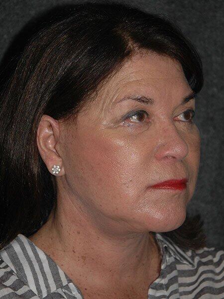 Blepharoplasty Before & After Photo