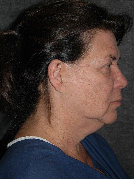 Blepharoplasty Before & After Photo