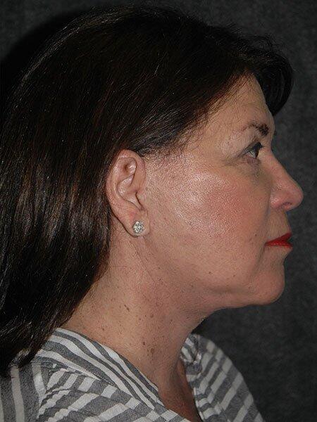 Blepharoplasty Before & After Photo