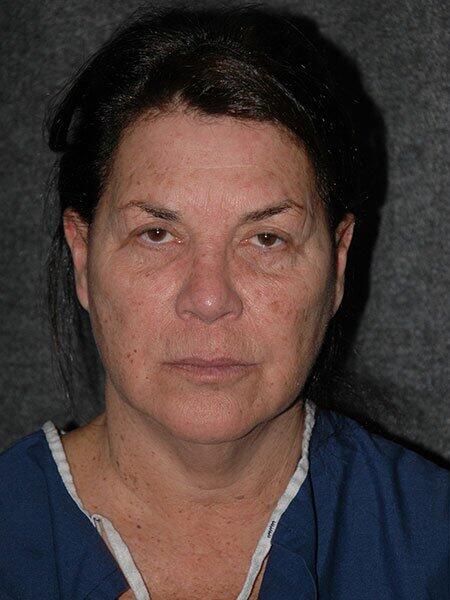 Blepharoplasty Before & After Photo