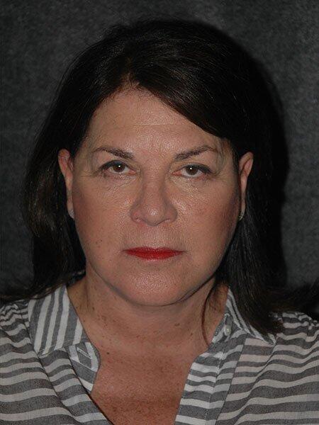 Blepharoplasty Before & After Photo