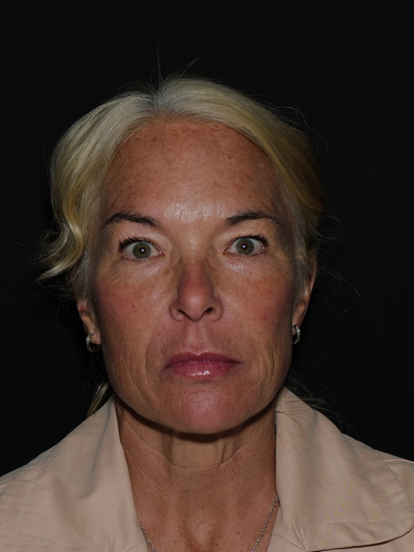 Blepharoplasty Before & After Photo