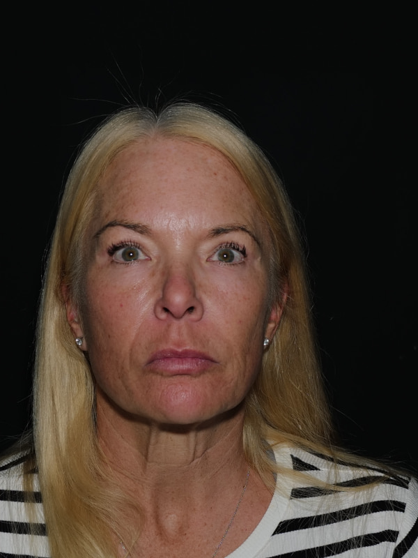 Blepharoplasty Before & After Photo