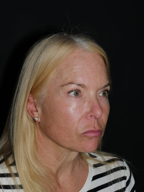 Blepharoplasty Before & After Photo